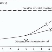 Gráfico 1. Curvas de presión supratentorial (A) e infratentorial (B), durante un experimento de masa supratentorial. Reproducción muy levemente modificada de Lofgren y Zwetnow, 1973<br />

