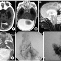 Foto 10. A: TAC de cerebro donde se observa imagen quística con calcificación periférica. B, C y D: IRM de cerebro con angioIRM en cortes axial y sagital. E y F: angiografía digital sin evidencia de impregnación patológica