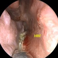 Figura 13: incisión horizontal inferior del HBF. De ser necesario, la misma puede realizarse sobre el borde más externo del piso nasal.