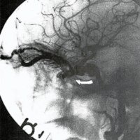 Fig. 12: Fístula con drenaje anterior a vena oftálmica (vista lateral).