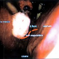 Fig. 3. En esta foto endonasal derecha se encuentra esquematizada la localización de la arteria esfenopalatina que debe ser respetada para evitar sangrados o con el objeto de preservar lairrigación del colgajo septal en el caso de ser necesario.