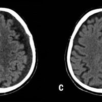 Figura 1: a) HSDSA – Hemiparesia derecha y somnoliencia; b) 2° día postopertaorio lucido sin foco neurológico; c y d) 45 días postoperatorio.