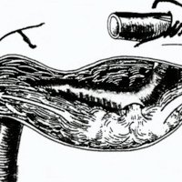 Fig. 3. Representación clásica de FCC: la arteria carótida se vacía directamente en un gran seno venoso único.