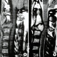 Fig. 1. IRM sagital, ponderada en T1 sin contraste (A) y T2 (B) donde se observa una lesión expansiva que compromete el cuerpo de C3 con Invasión al canal espinal.