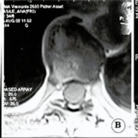 Fig. 3. Caso n° 6, IRM. A. Sagital ponderada en T1 que muestra el tumor. B. Axial ponderada en T I que muestra el tumor, C, Axial ponderada en Ti que muestra el control postoperatorio y la apertura ósea (flecha).