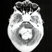 Fig. 1. Prequirúrgico de papiloma de IV ventrículo.