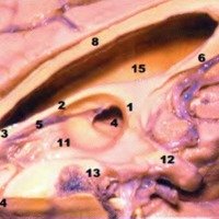 Fig. 20. Corte sagital del encefalo; vista medial del TV de un espécimen que presentaba un quiste coloideo; dicha lesión fue extraída para apreciar el AM agrandado