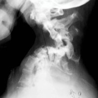 Figura 1: Rx cervical de ingreso evidenciando derrumbamiento vertebral. Nótese como los cuerpos de C3 y C5 entran en contacto.