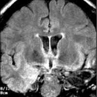 Fig 6. IRM de cráneo, corte coronal, secuencia FLAIR: Cambios postquirúrgicos identificándose cavidad operatoria que involucra región polar y mesial temporal izquierda.