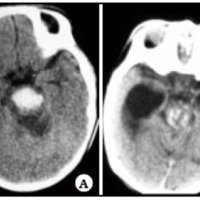 Fig. 3. A: TAC donde se observa hematoma en mesencéfalo. B: TAC control postoperatoria donde se observa hidrocefalia.
