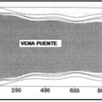 Fig. 7. Variaciones del diámetro de una vena puente con distintas presiones intracraneanas, levemente modificado de (42). SLS: seno longitudinal superior. Se puede constatar que las venas no se colapsan incluso con presiones intracraneanas muy altas. Solamente disminuyen su calibre levemente.