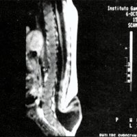 Fig. 1. Caso 3: MMC epitelizado no operado hasta los 9 meses de vida. No se observa otra patología