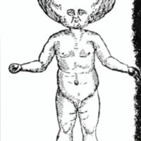 Fig, 1. Caso histórico de hidrocefalia del siglo XVI
