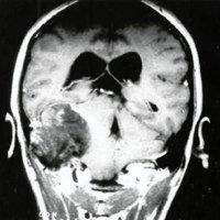 Fig. 3 (Caso 2). IRM: tumor hipointenso en el ángulo pontocerebeloso derecho, con osteólisis de peñasco y escama occipital. 