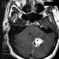 Figura 7: Tipo de HEB. Lesión quística con nódulo mural (izquierda), sólida con quiste intratumoral (centro) y sólida (derecha).