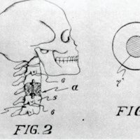 Figuras 2 y 3. Dibujos técnicos que muestran la prótesis y sus aplicaciones (ver texto).