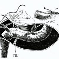 Fig. 5: Esquema en vista lateral de la carótida intracavernosa derecha con sus ramas. (ACI: art. carótida interna; TMH: tronco meningohipofisario; TIL: tronco inferolateral; AC: art. pulmonar; AO art. oftálmica).