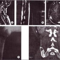 Fig. 4. IRM. A, B y C: lesiones espinales (C2, D12) y calota craneana. D y E: Rx y TAC: lesiones liticas en húmero y pelvis.