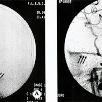 Fig 1. Angiografia Digital de FCC postraumática sin fenómeno de "robo" hemodinámico. 