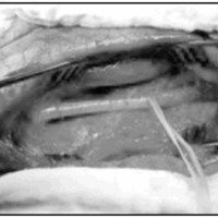 Fig. 2. Exposición quirúrgica del nervio ciático en la pierna.