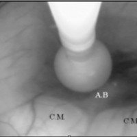 Fig. 1. Tercer ventriculostomía endoscópica, inflado del catéter balón. C.M.: cuerpos mamilares. A.B.: arteria basilar