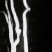 Fig. 2: Imagen angiográfica por IRM de estenosis carotídea.