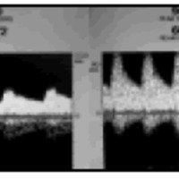 Fig. 2. Monitoreo intraoperatorio, obsérvese el cambio en la velocidad media de la ACM antes (izquierda) y después de la endarterectomía (derecha).