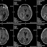 Glioma maligno radioinducido asociado a meduloblastoma: reporte de un caso y revisión bibliográfica