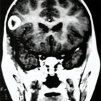 Fig. 3. IRM de ingreso, corte coronal, supratentorial. La lesión frontal muestra la clásica necrosis central, No se observan elementos reaccionales peritumorales.