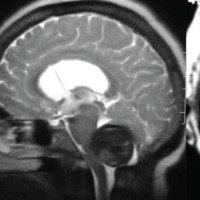 Figura 1: Aneurisma PICA gigante observado en angiografía y resonancia magnética preembolización.