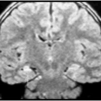 Fig. 27: Corte coronal FLAIR pre op. Imagen compatible con ETM derecha.