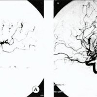 Fig. 4. Malformación arteriovenosa de localización temporal. A. Angiografía preoperatoria. B. Angíografía postoperatoria
