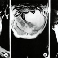 Fig. 3: IRM ponderadas en Ti con gadolinio que muestran en: a) el corte coronal un tumor hiperintenso en reloj de arena con desplazamiento medular: b) el corte axial a la médula deformada por el tumor ; c) el corte sagital al tumor ocupando todo el diámetro del canal.