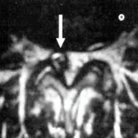 Fig 1. Caso 2: IRM: corte axial en T2