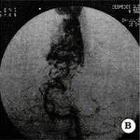 Fig. 2. Malformación arteriovenosa Grado III de ubicación rolándica A y B. Angiografias preoperatorias. C. Angiografia postoperatoria