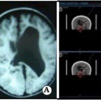 Fig 1. A. IRM prequirúrgica de un paciente con ventrículo excluido. B. NNV durante la cirugía (se ingresa por el ventrículo pequeño). 