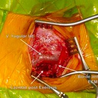 Figura 9: Finalizada la resección tumoral se observa la ventana de trabajo quirúrgico<br />
y el ingreso a la cavidad que ocupaba la lesión. ECM: Músculo esternocleidomastoideo.