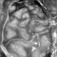 Fig. 14. Imagen intraoperatotia pre-resección.Se observan venas arterializadas. La MAV está sobre la cara medial del frontal, en la cisura interhemisférica.