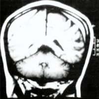Fig. 1. IRM que muestra un HSE bilateral.