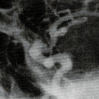 Figura 13: Aneurisma carótidooftálmico anterior. En este caso parece organizarse por delante de la arteria oftálmica.