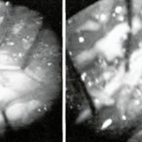 Fig. 3. Imágenes intraoperatorias. A. Cápsula del quiste dermoide intramedular. B. con pelos en su interior.