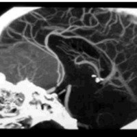 Fig 2. Desplazamiento posterior de ambas arterias cerebrales anteriores.