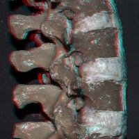 Figura 2: Vista lateral derecha del modelo cadavérico. Osteotomía de grado 1. Resección parcial de la faceta descendente de L3. Se observa la anatomía del foramen intervertebral. 