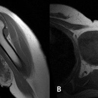 Figura 2: A) RMI hombro izquierdo corte coronal T2. B) RMI hombro izquierdo corte sagital T2.