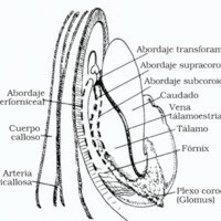 Fig. 13. Abordajes laterales al techo. Vista del ventrículo lateral derecho, (Modificado de Apuzzo).