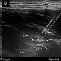 Bloqueo perioperatorio interfascial del plano del erector<br /><br />
espinal lumbosacro para el manejo del dolor postoperatorio en<br /><br />
cirugía de columna espinal: estudio prospectivo, randomizado