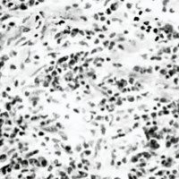 Fig. 4. Hematoxilina-eosina: acú mulo linfoplasmocitario, histiocitos y áreas de tejido colágeno. Lesión compatible con pseudotumor inflamatorio.