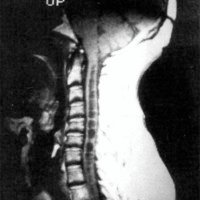 Fig. 3. Paciente con malformación de Arnold-Chiari tipo 1 asociada a cavidad siringomiélica. Imagen preoperatoria.