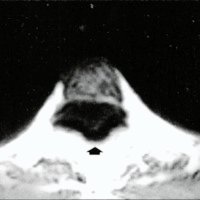 Fig. 2: Corte horizontal de imágenes ponderadas en T1 que muestran como el tumor ocupa el canal espinal casi completamente. 