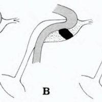 Fig. 15. Esquema en vista lateral derecha de laformación de un pseudoaneurisma posterior ala oclusión con balón de una FCC. 